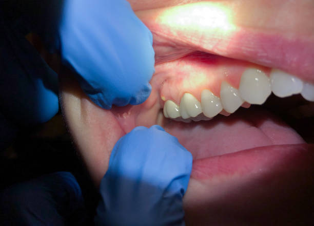 Best Emergency Dental Services for Seniors in Fredericksburg, TX