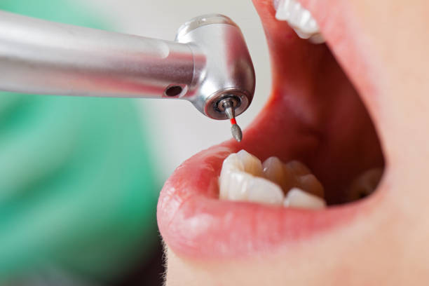 Best Emergency Dental Extractions in Fredericksburg, TX